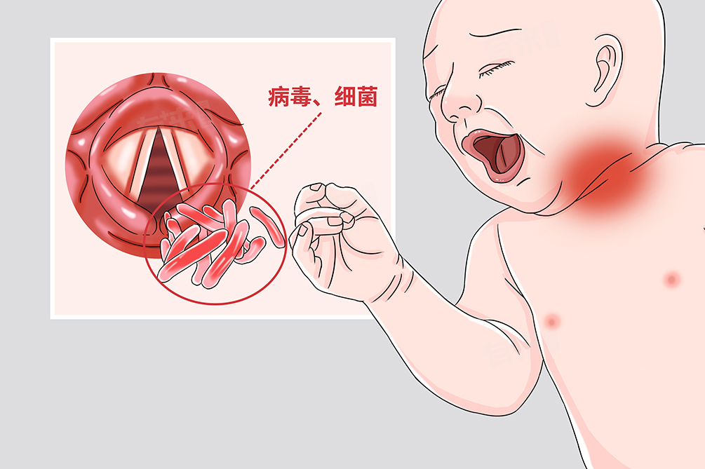 六个月宝宝声音沙哑怎么办